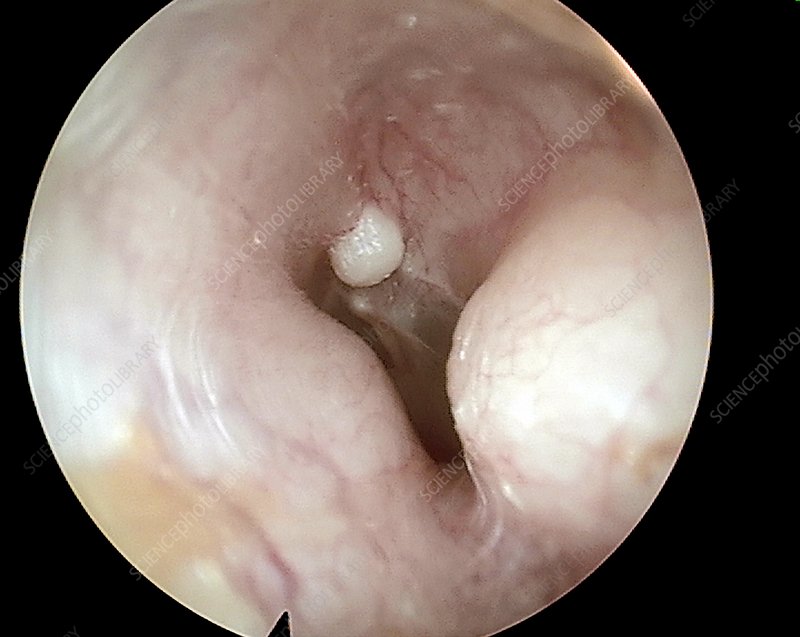 Osteoma Swelling In Ear Canal, Otoscope View